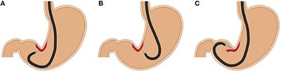 The Pocket-Creation Method Facilitates Endoscopic Submucosal Dissection of Gastric Neoplasms Along the Lesser Curvature at the Gastric Angle